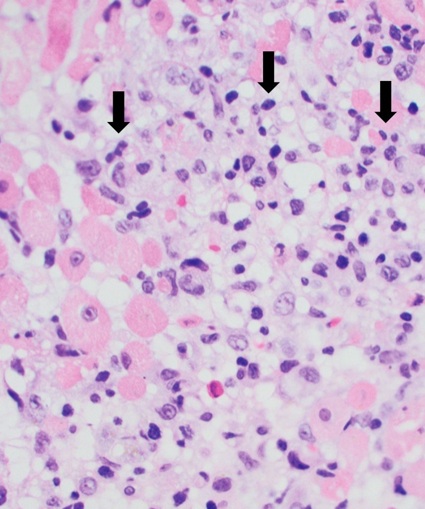 Heart biopsy sample with acute myocarditis.jpg