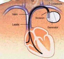 Arrhythmias