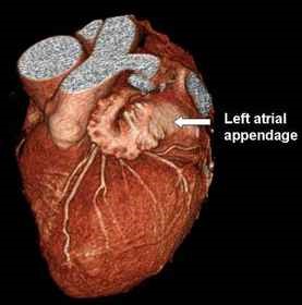 Arrhythmias