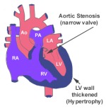 Aortic Stenosis 