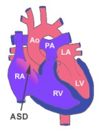 Atrial Septal Defect 