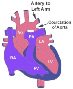 Coarctation of aorta 