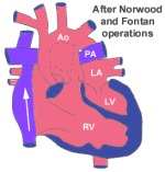 Hypoplastic Left Heart Syndrome (Norwood Operations) 