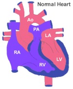 Atrial Septal Defect 