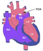 Patent Ductus Aeteriosus (PDA) 