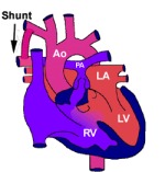 Tetralogy of Fallot 