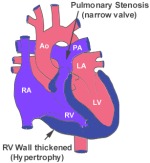 Pulmonary Stenosis 