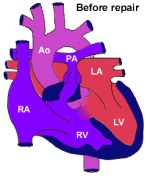 Tetralogy of Fallot 