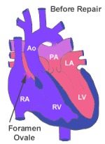 Defects involving the Great Arteries