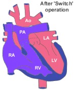 Defects involving the Great Arteries