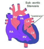 Aortic Stenosis 