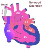 Hypoplastic Left Heart Syndrome (Norwood Operations) 