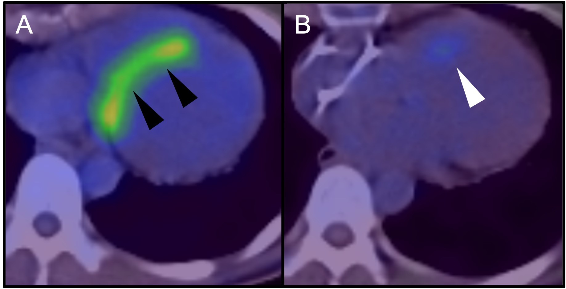 Cardiac Sarcoidosis.jpg