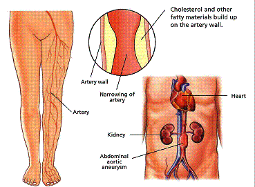 vascular disease.gif