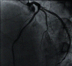 acutecoronary