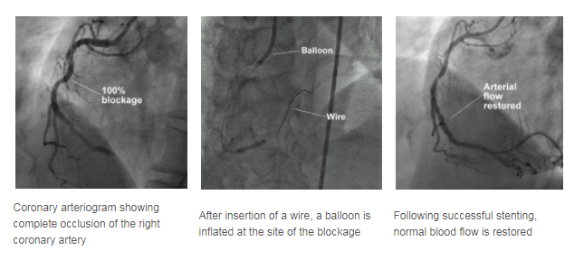 Success images of Coronary Angioplasty