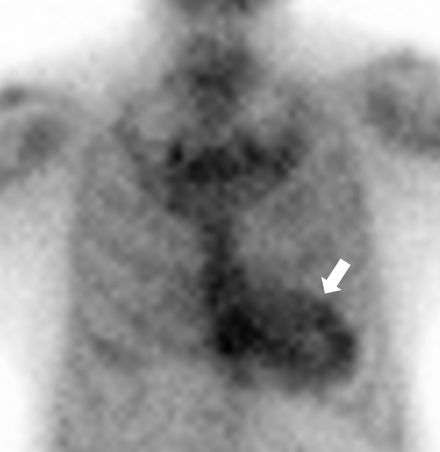 Amyloid Cardiomyopathy