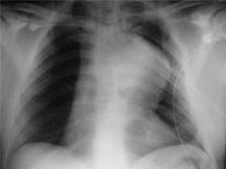 Chest X-ray