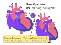 Ross Operation