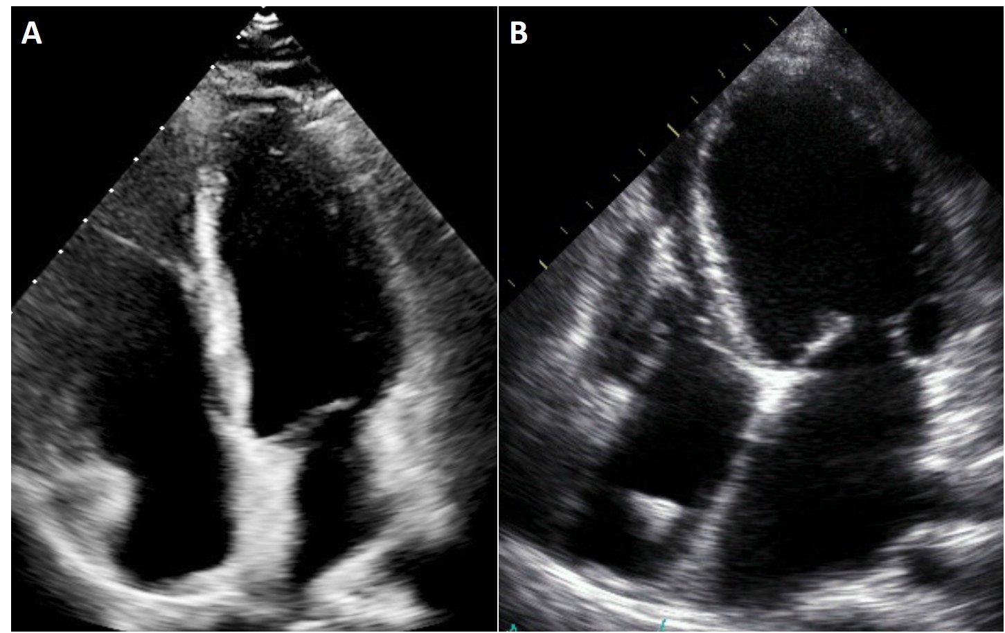 Dilated Cardiomyopathy