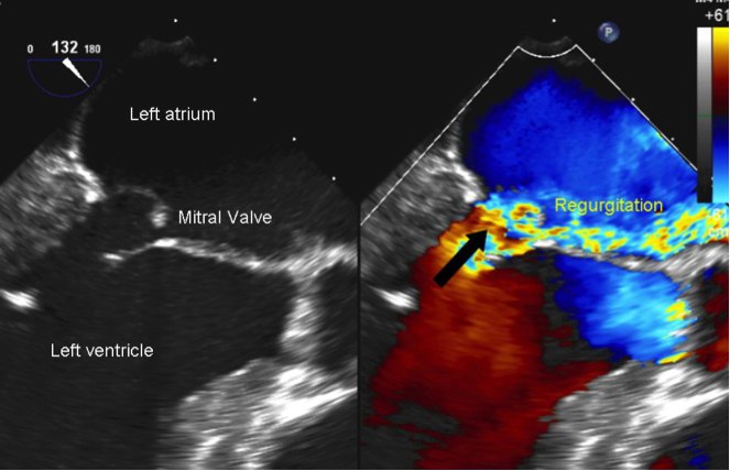 The mitral valve