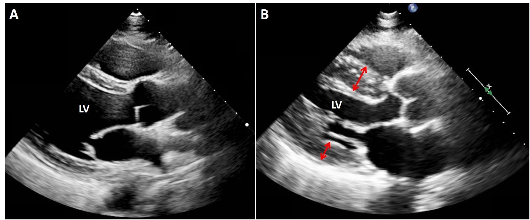 Echocardiogram of a normal heart vs with hypertrophic cardiomyopathy