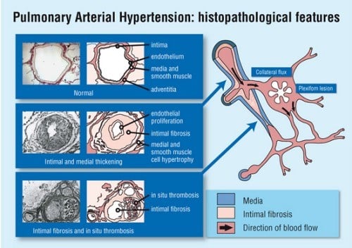 Pulmonary Arterial Hypertension infographic