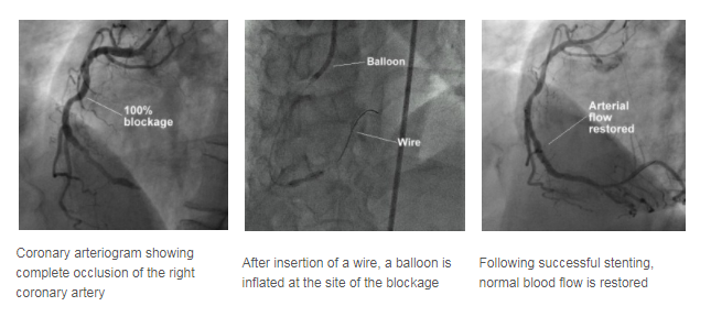 Stenting procedure