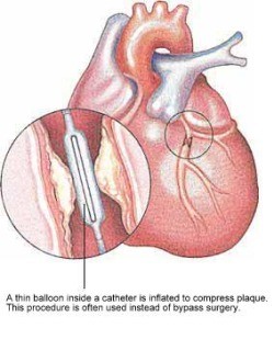 A thin balloon inside a catheter