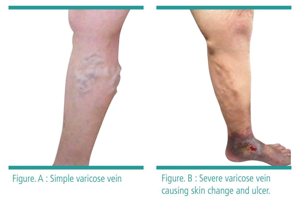 Images of simple to severe varicose vein