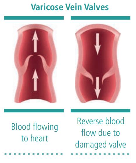 Varicose Veins Valves