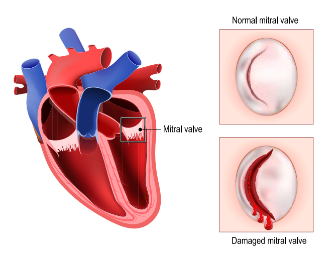 Mitral Valve