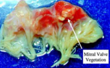 Mitral Valve Vegetation