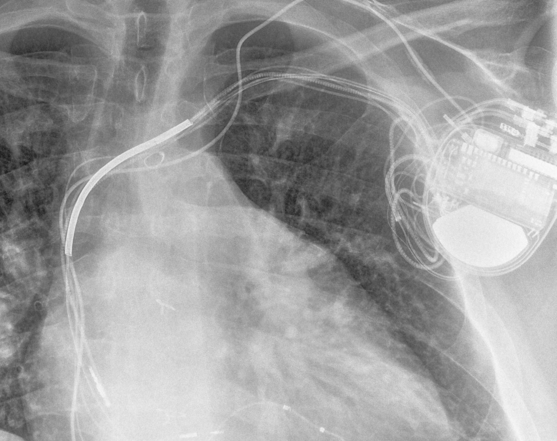 Electrophysiology and Pacing