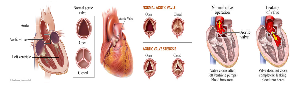 Aorta Valve Infographic