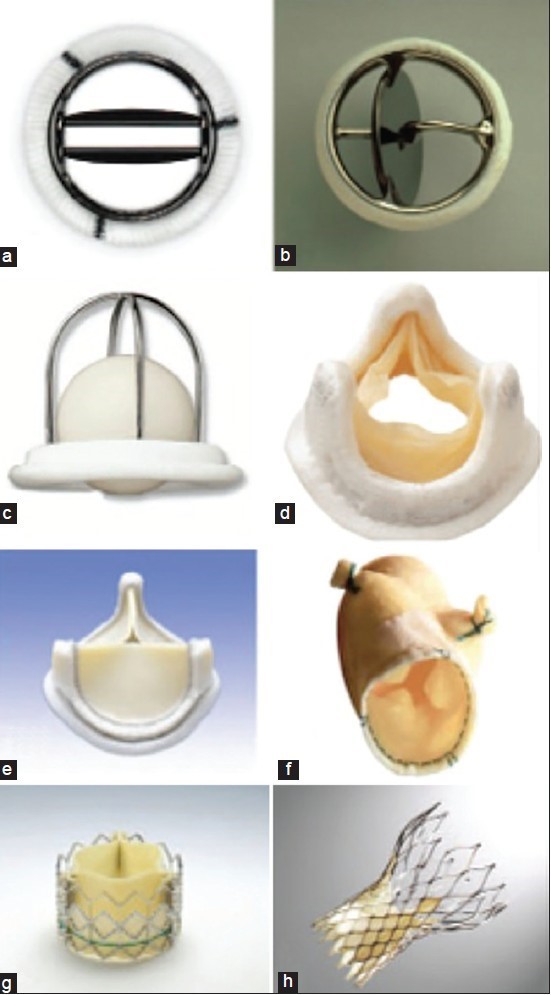 Aortic Valve Prosthesis