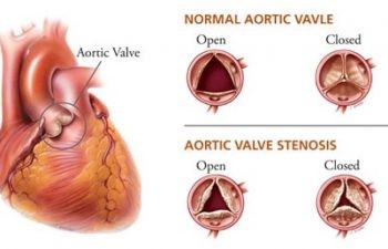 Aortic Valve Surgery