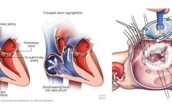 Minimally Invasive Arrhythmia Surgery /Atrial Ablation