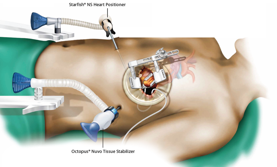 Illustrated image of the MIDCABG and MVST