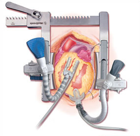 Heart Positioning Devices