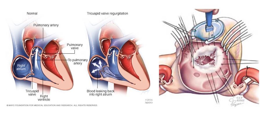 Tricuspid Valve Regurgitation